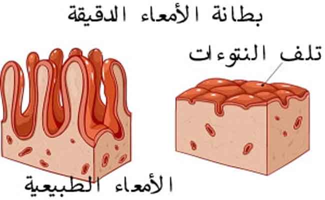 ما هو مرض السيلياك وأعراضه؟...وأفضل علاج