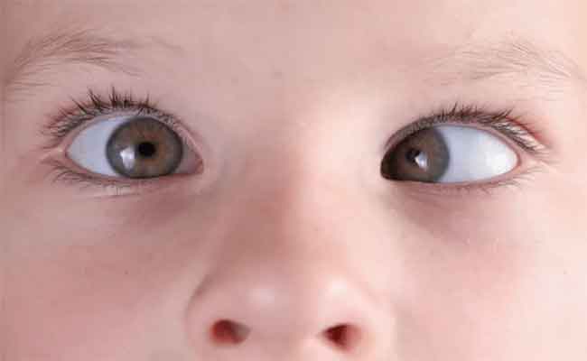 أسباب حول العين عند الأطفال والطريقة الصحيحة لعلاجه...