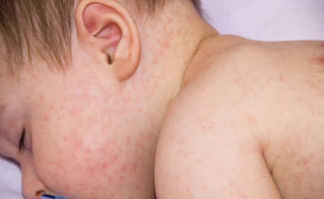 علامات الحساسية الغذائية عند الأطفال وكيفية علاجها...