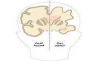 الزهايمر: علاج محتمل بناء على دراسات علمية حديثة