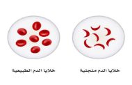 اليوم العالمي للأنيميا المنجلية: أعراض وأسباب المرض وطرق علاجه