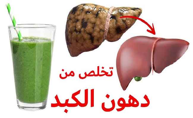 علاج دهون الكبد في المنزل ممكن بتغيير بعض العادات
